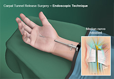 Carpal Tunnel Release Surgery