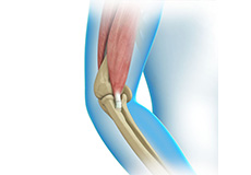 Elbow Tendon Repair