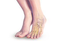 Nerve Conditions of the Foot