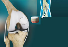 Osteochondral Defects