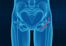 Outpatient Hip Replacement