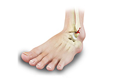 Stress Fractures of Foot and Ankle